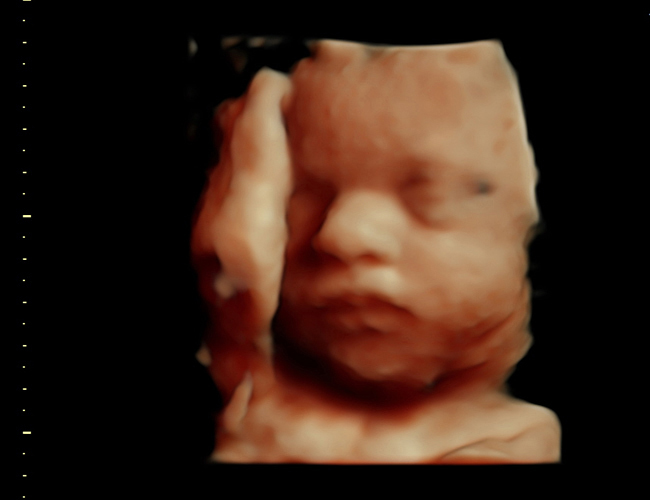 3D ultrasound image at 31 weeks